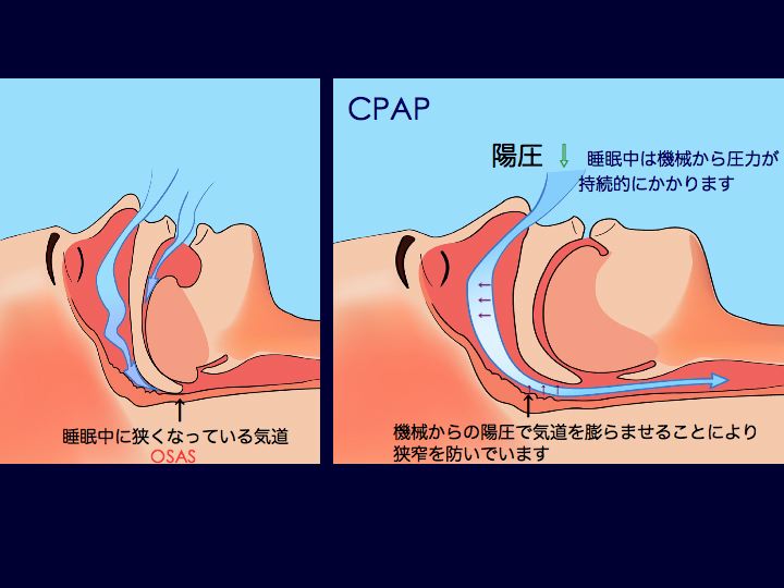CPAPの図1